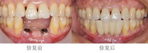 ����ȱʧΪʲôѡ��ֲ��,��ֲ��ǰ��Ա�